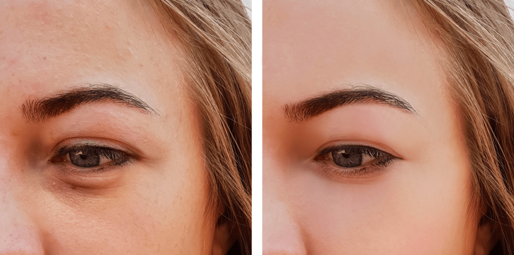 Eyelid Surgery Before After