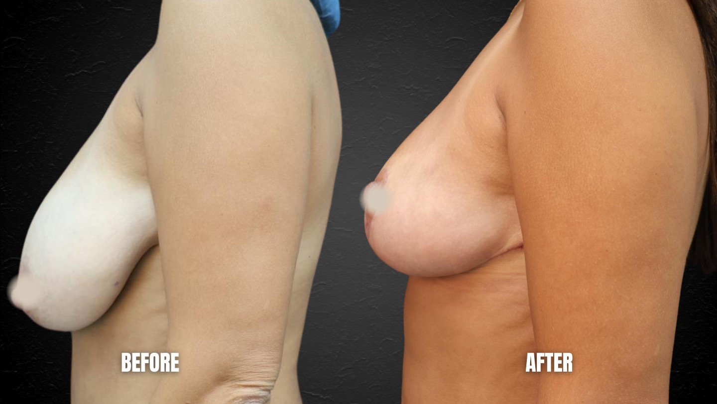 Breast Reduction Miami