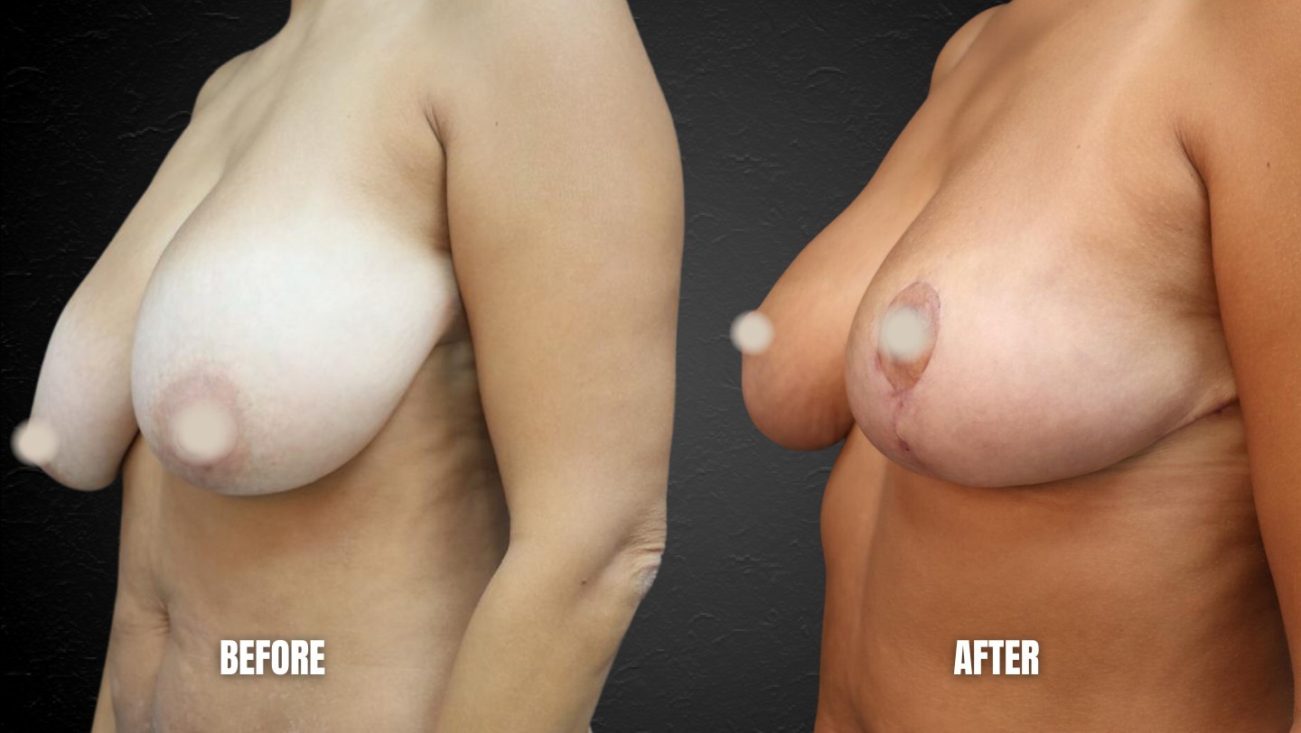 Breast Reduction Miami