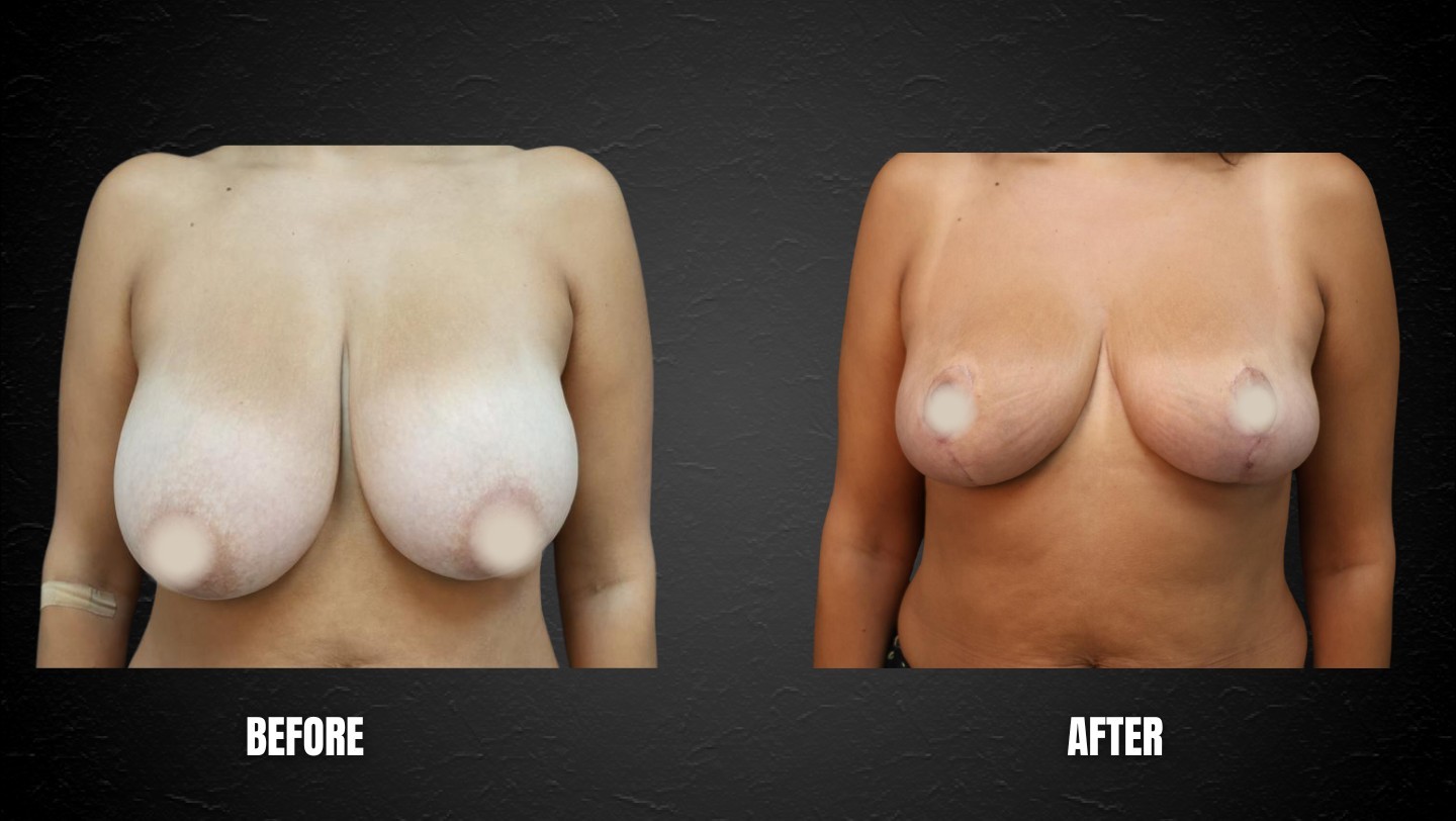 Breast Reduction Miami