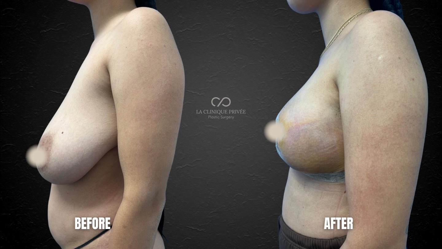Breast Reduction Miami