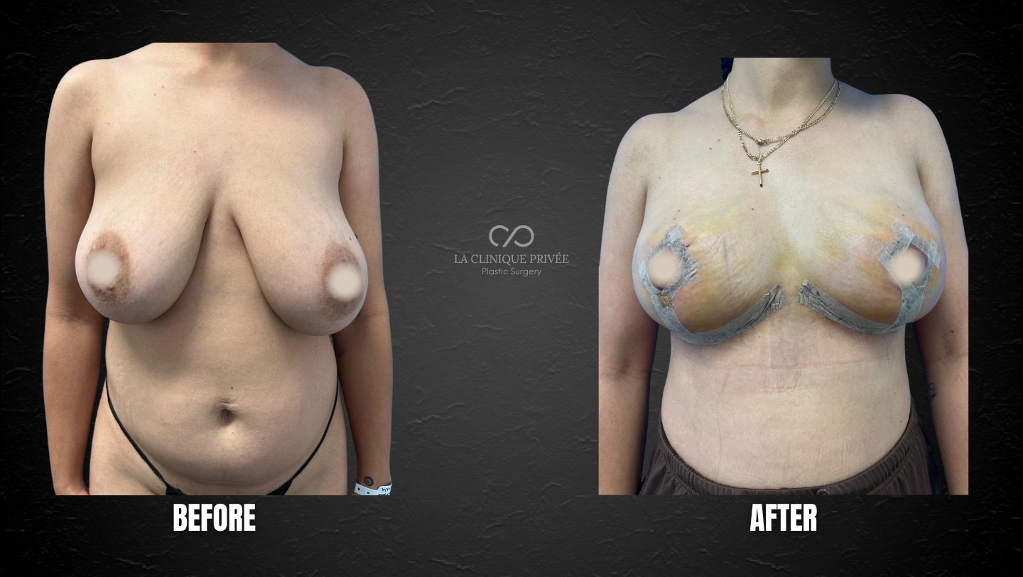 Breast Reduction Miami