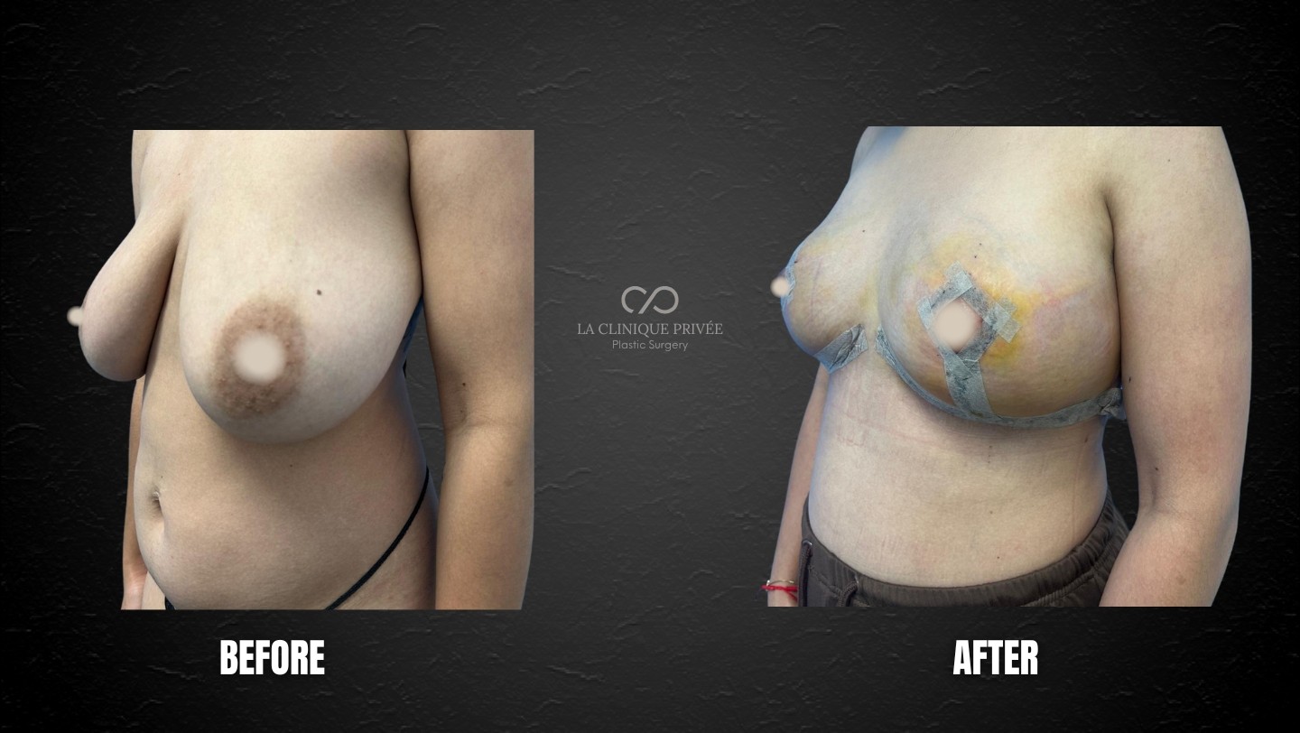 Breast Reduction Miami