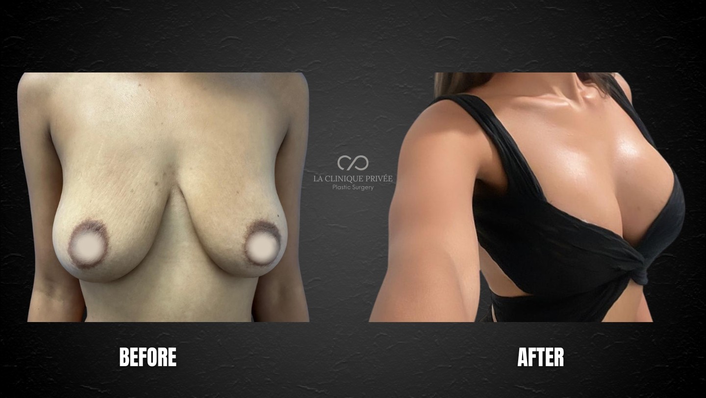 Breast Lift