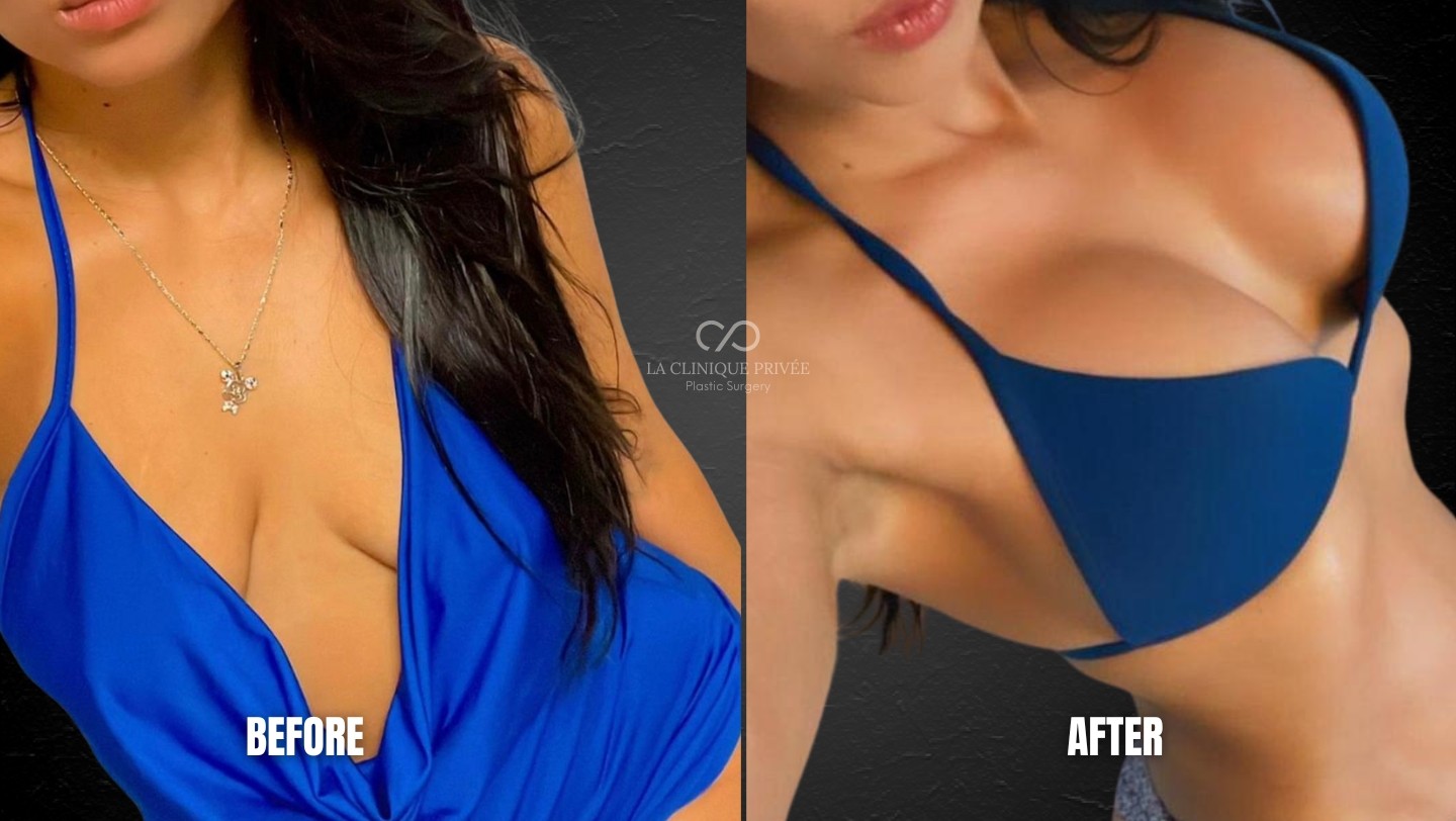 Breast Lift