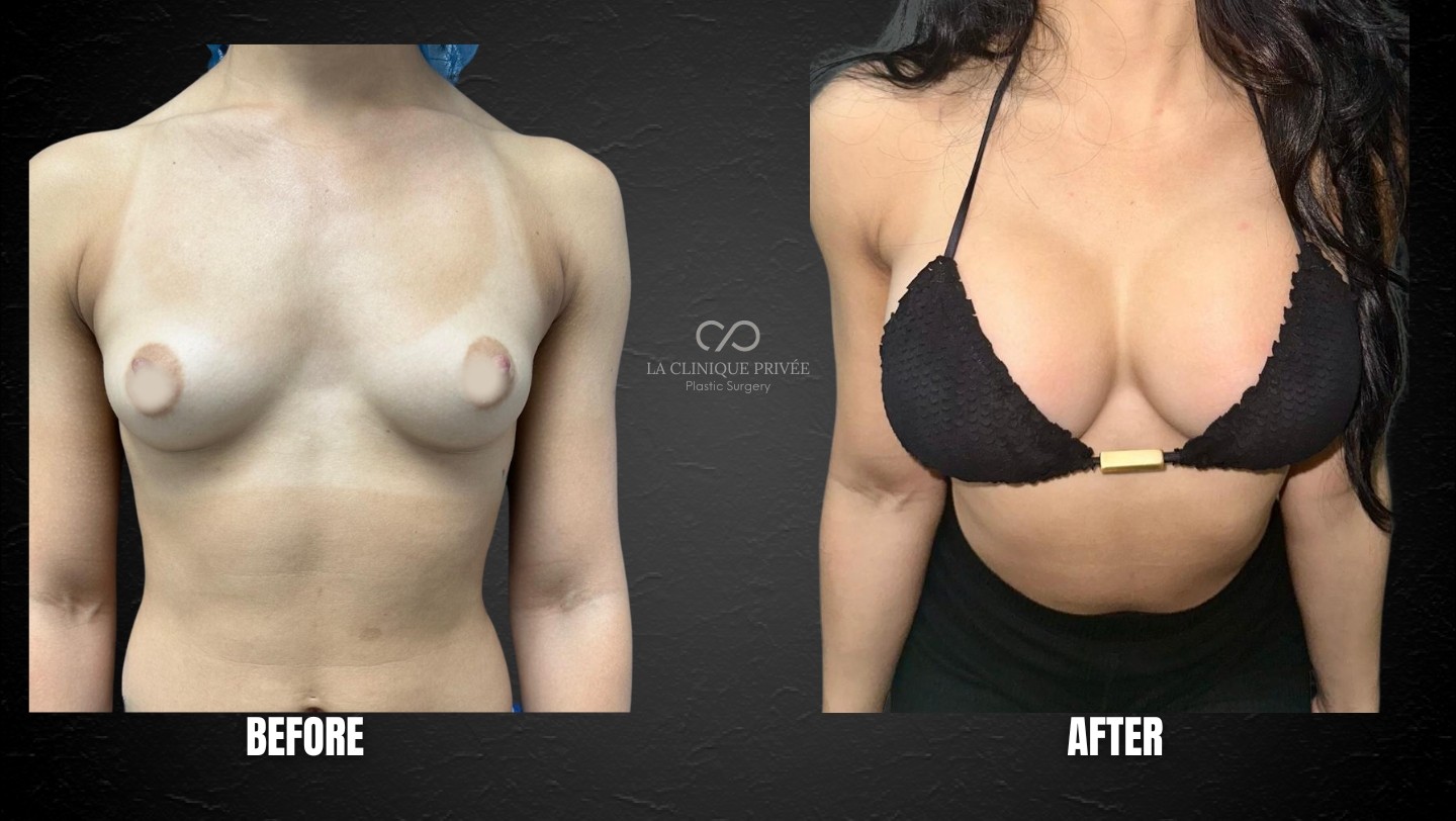 Breast Augmentation Miami