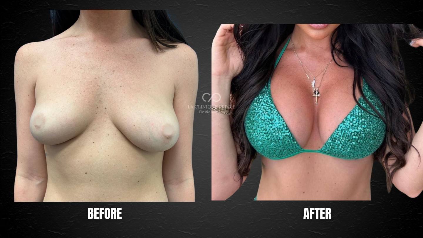 Breast Augmentation Miami