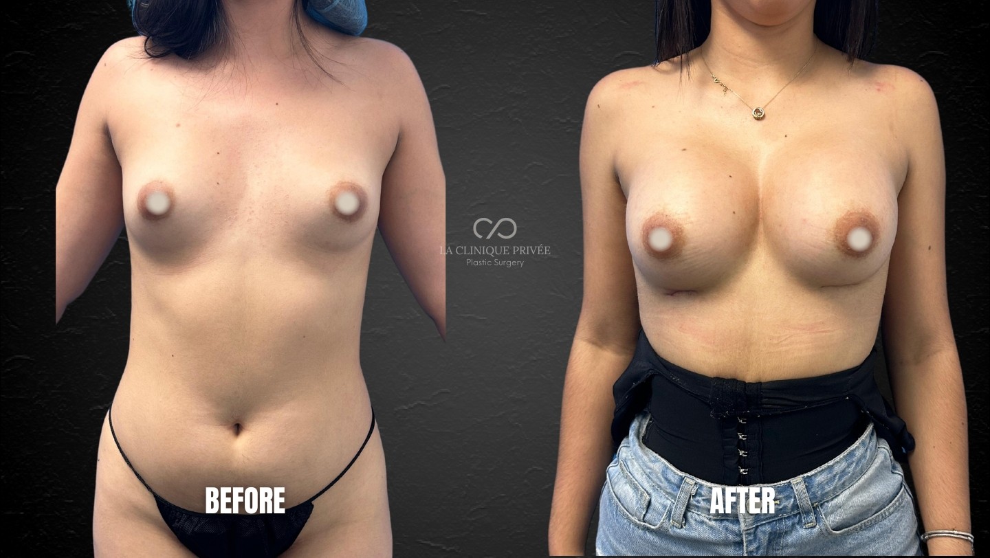 Breast augmentation