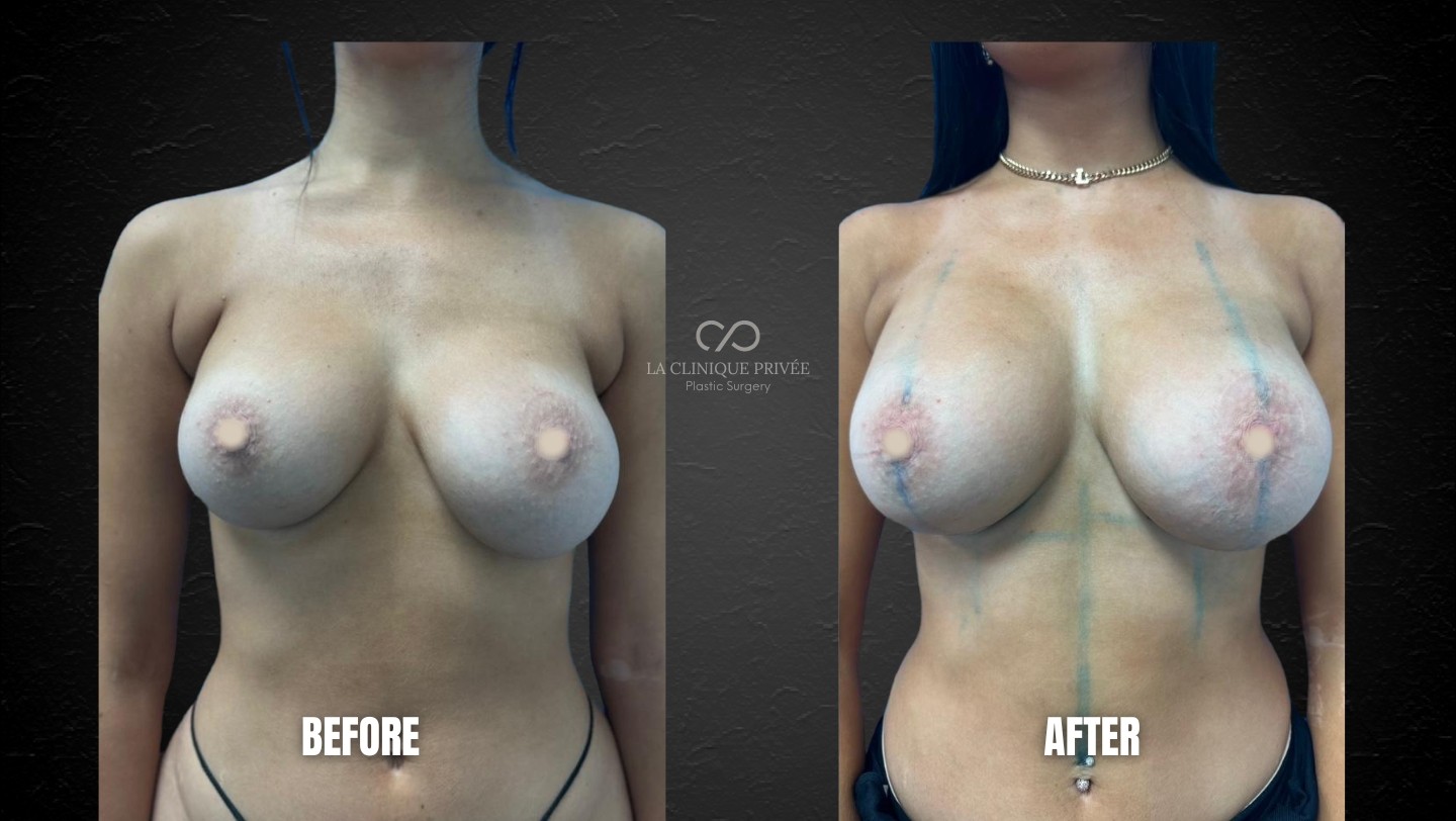 Breast augmentation Revision