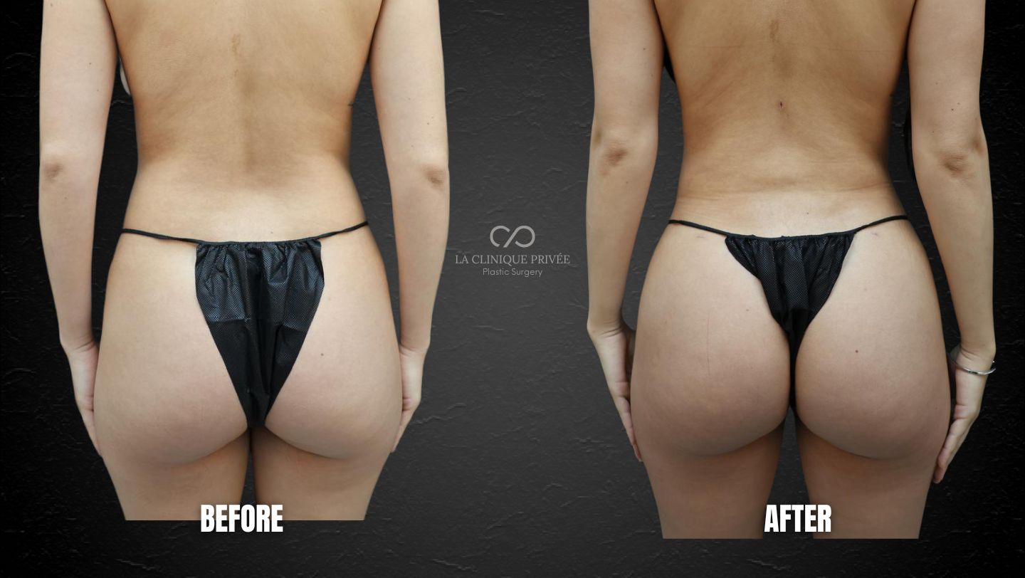 Brazilian Butt Lift Miami