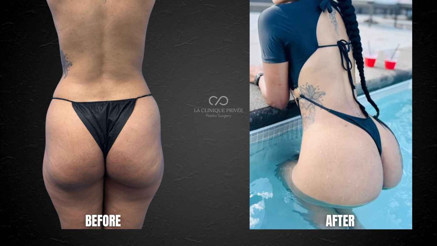 Brazilian Butt Lift Miami