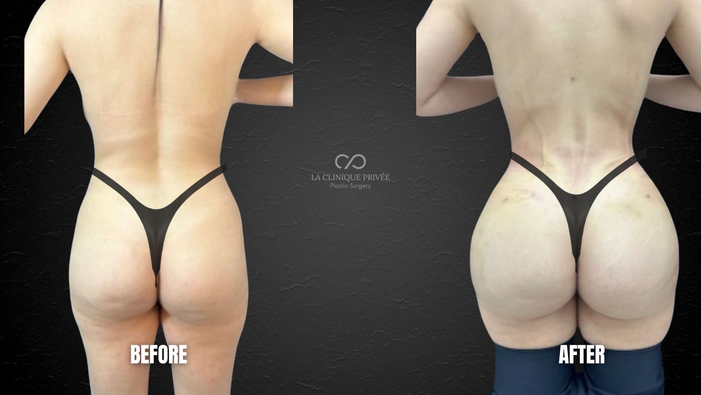 Brazilian Butt Lift Miami