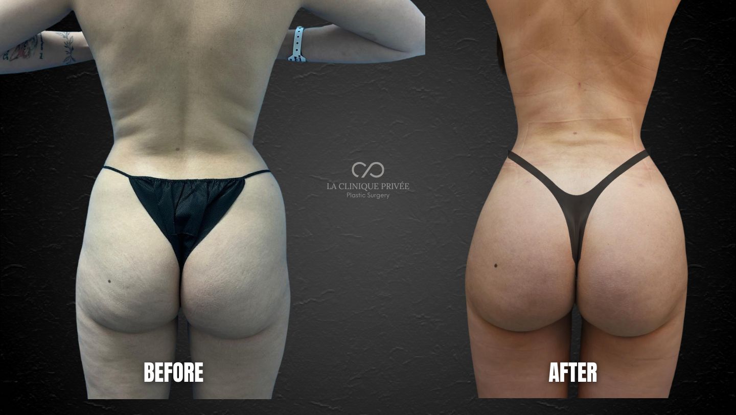 Brazilian Butt Lift Miami
