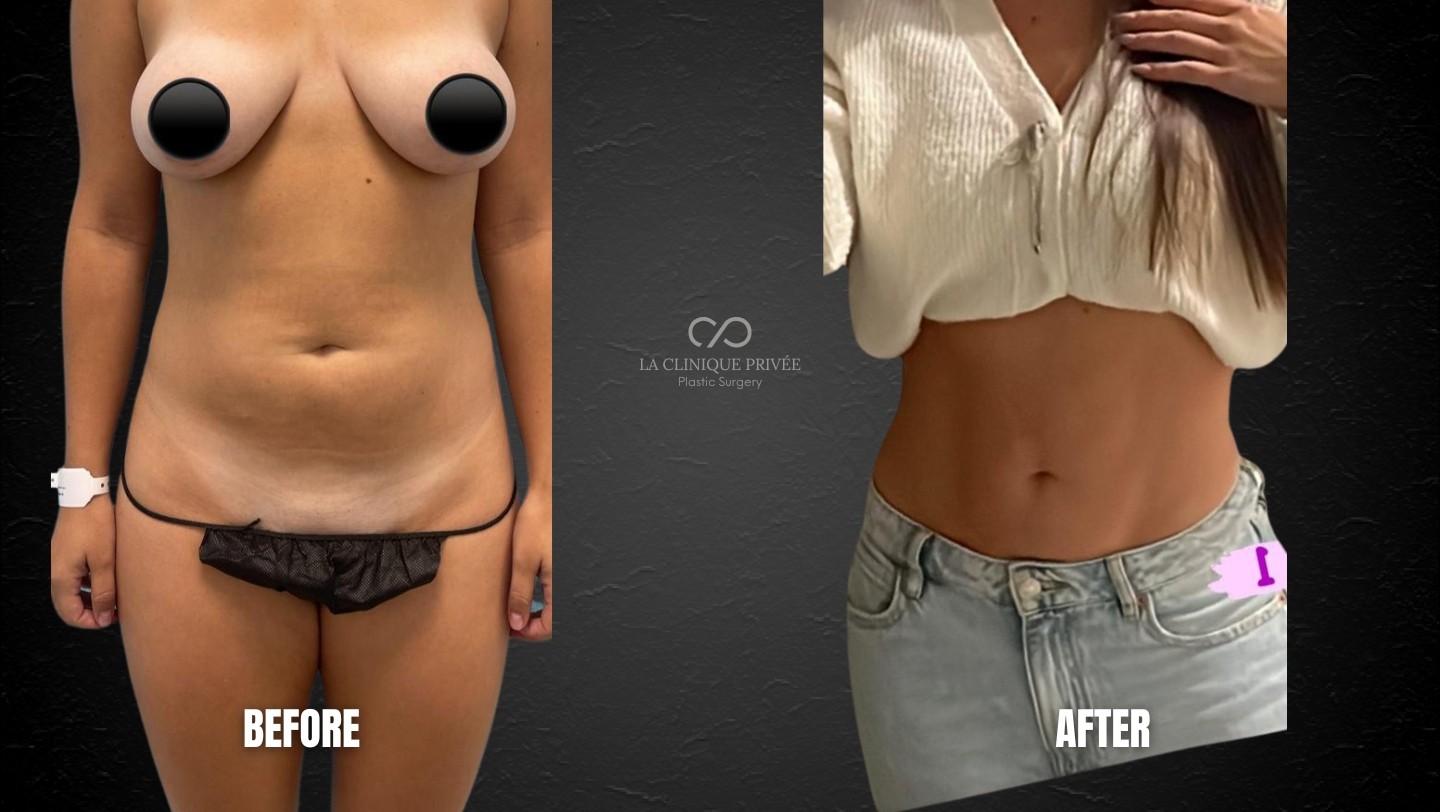 Liposuction Miami