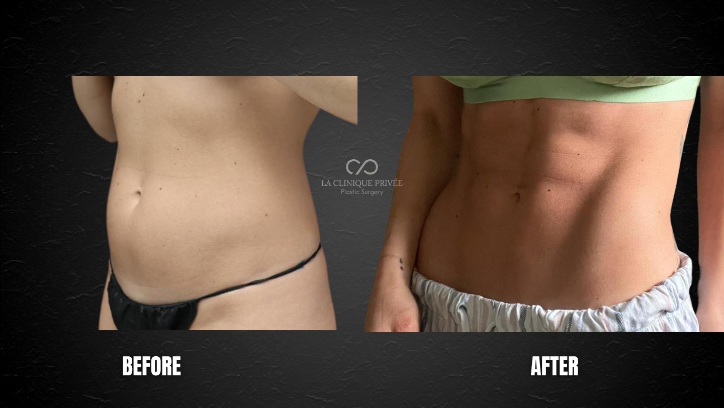 Liposuction Miami