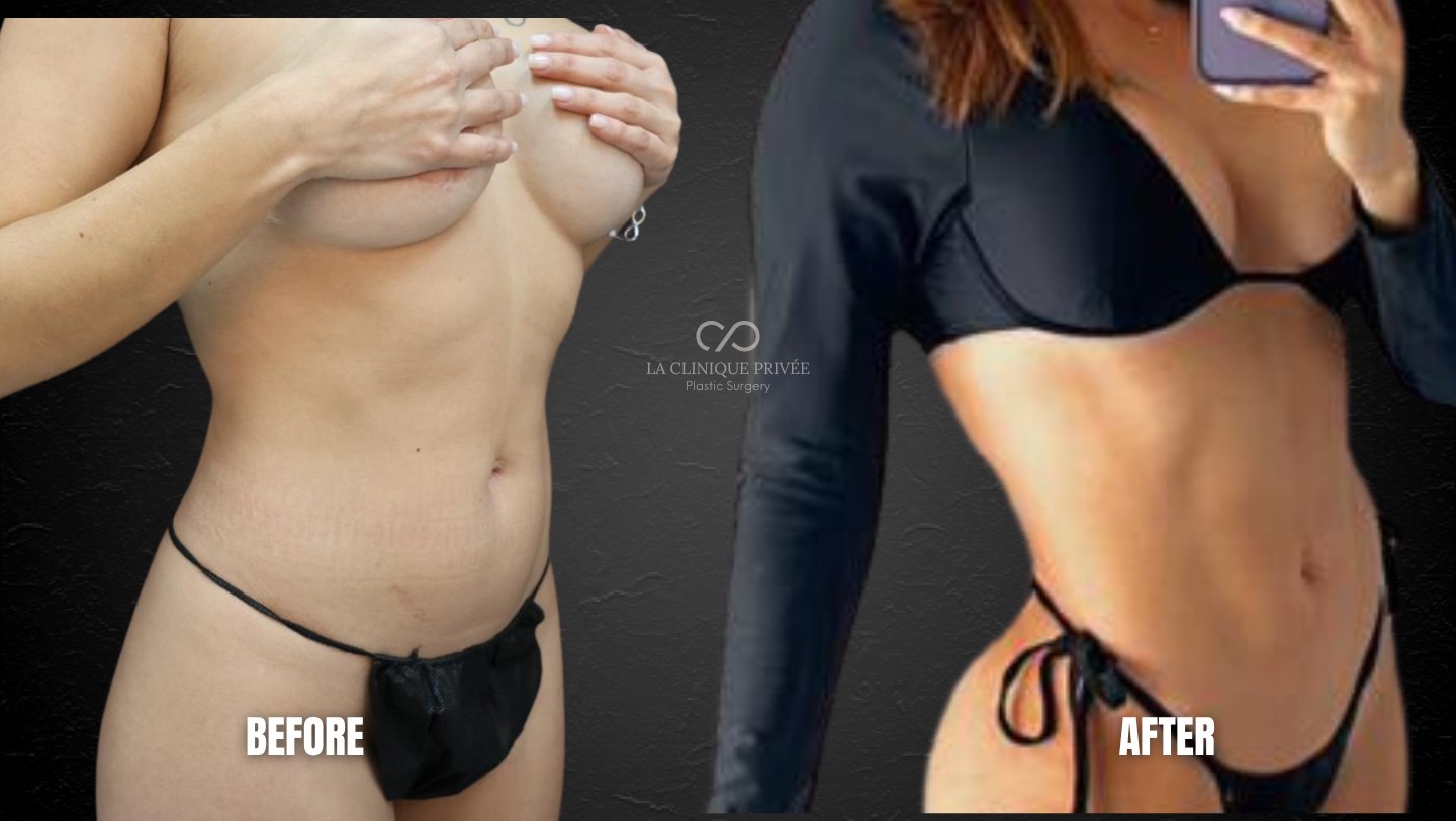 Liposuction Miami