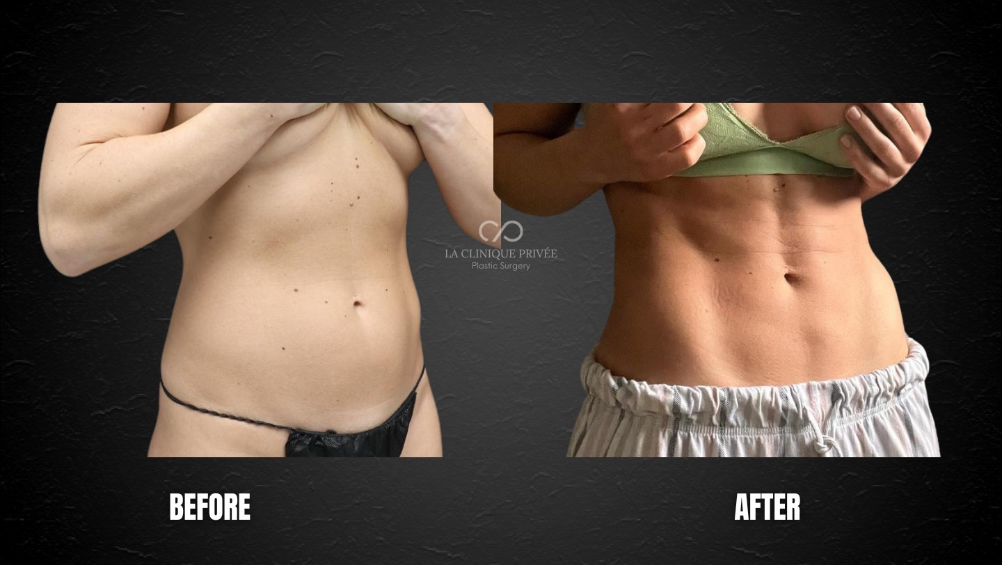 Liposuction Miami