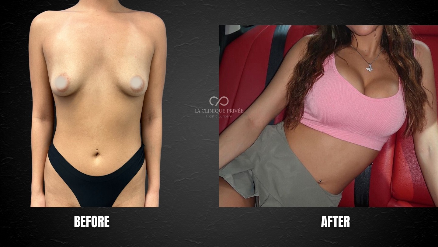 Breast Lift Plastic Surgery