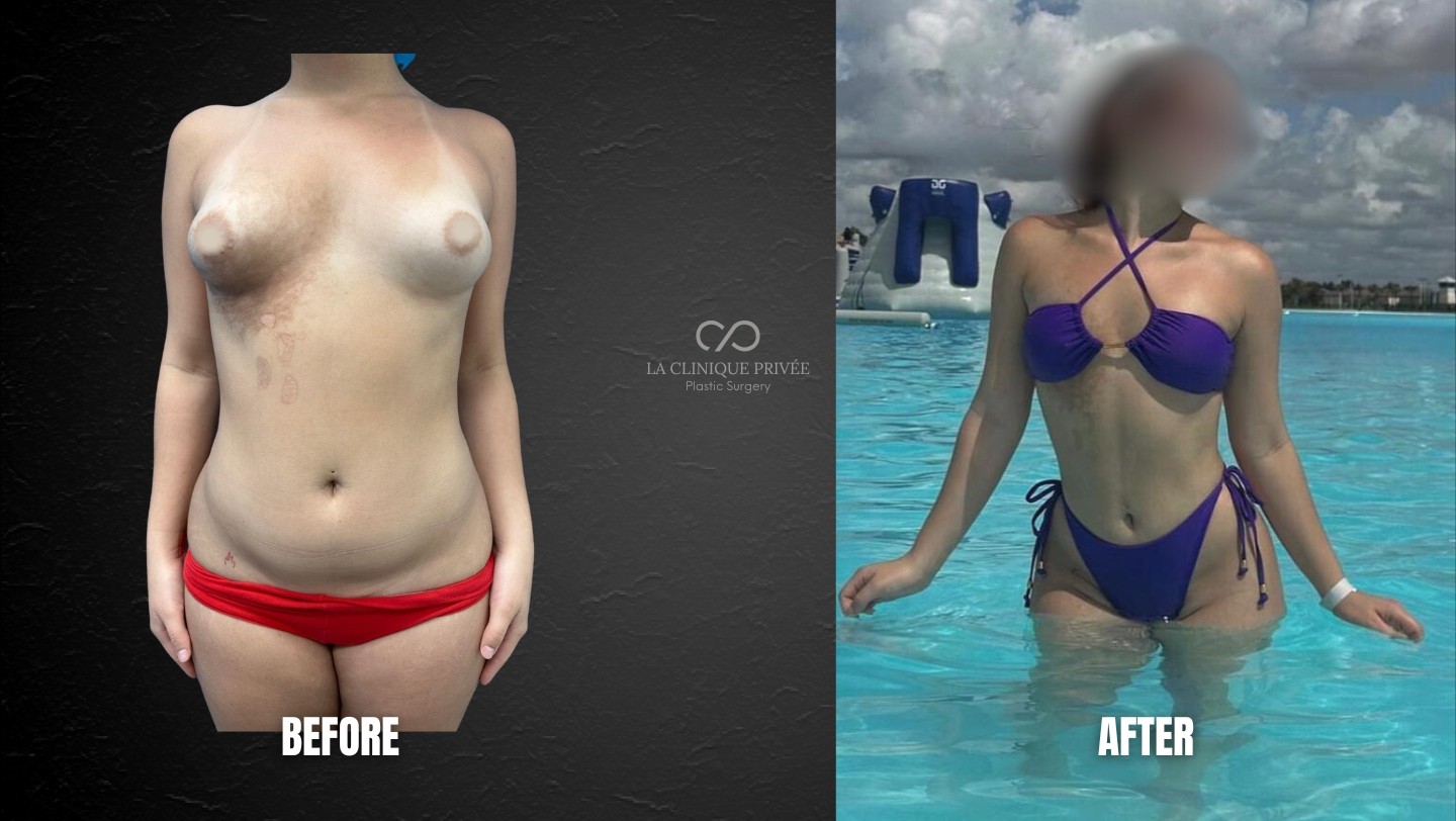 Liposuction