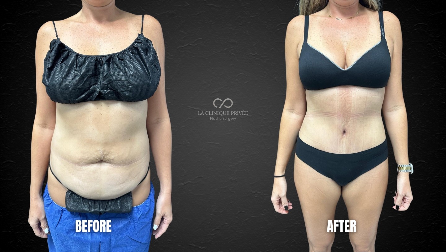Tummy Tuck