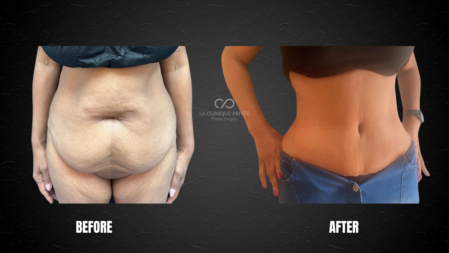 Tummy Tuck