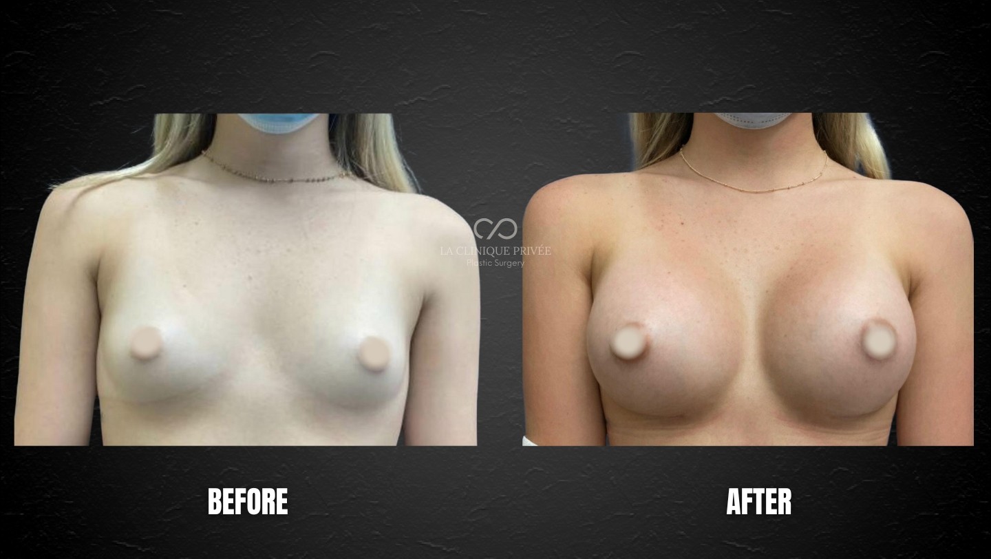 Breast Augmentation Miami