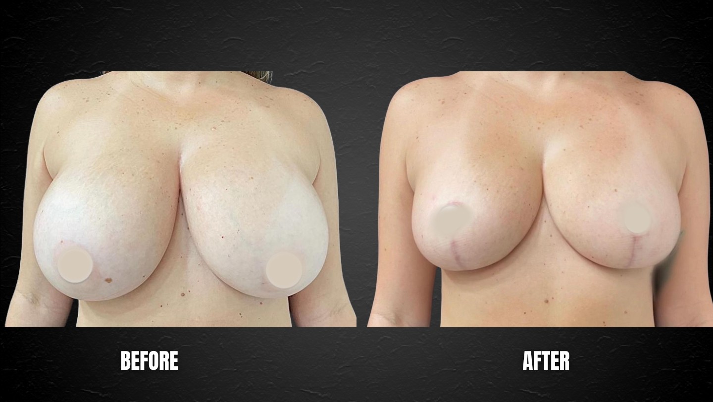 Breast Reduction Miami