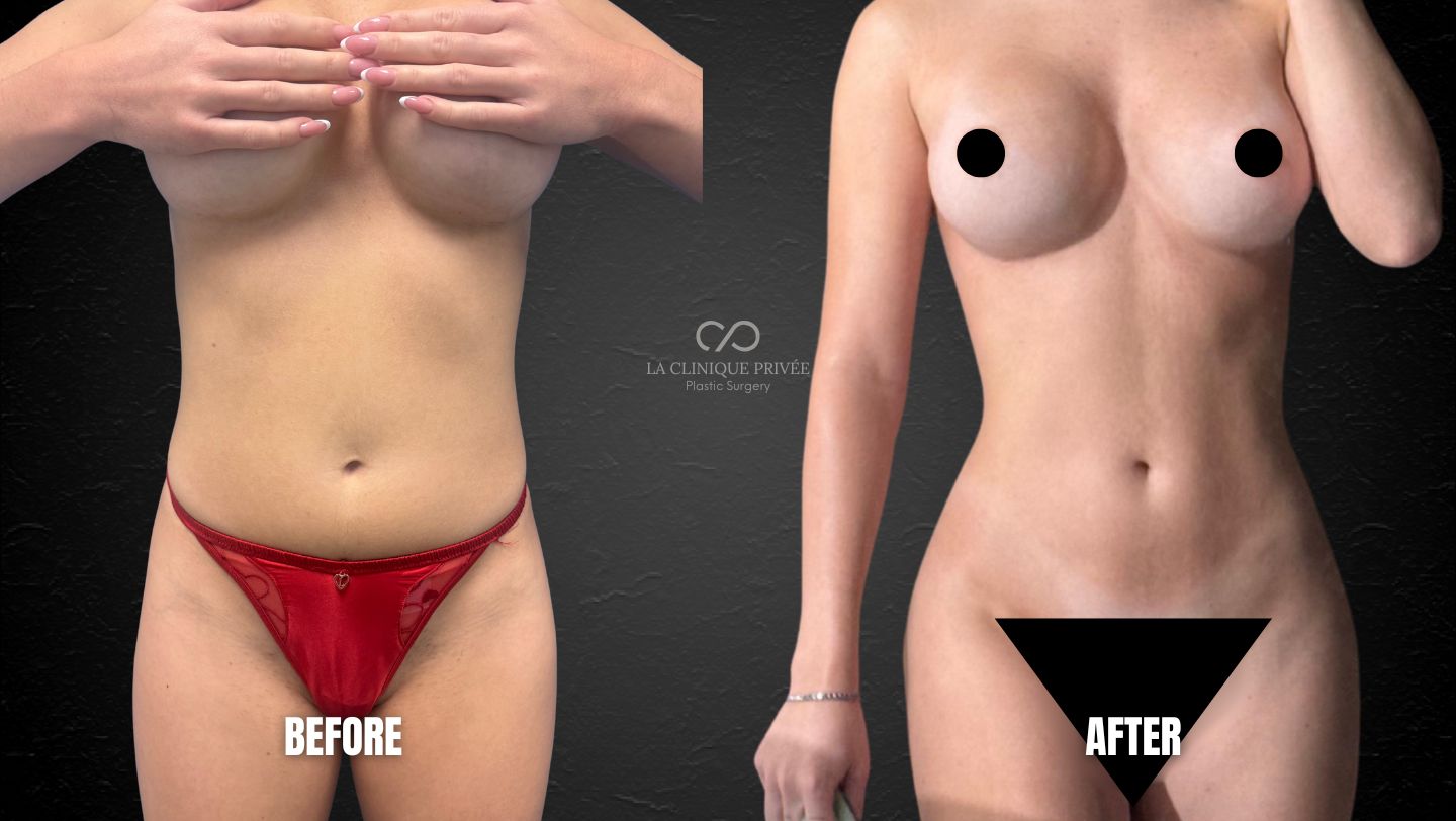 Abdominal Etching